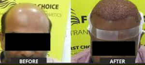 singapore-hair-transplant-before-after-picture