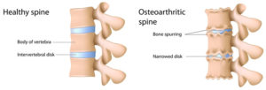 spinal-arthritis